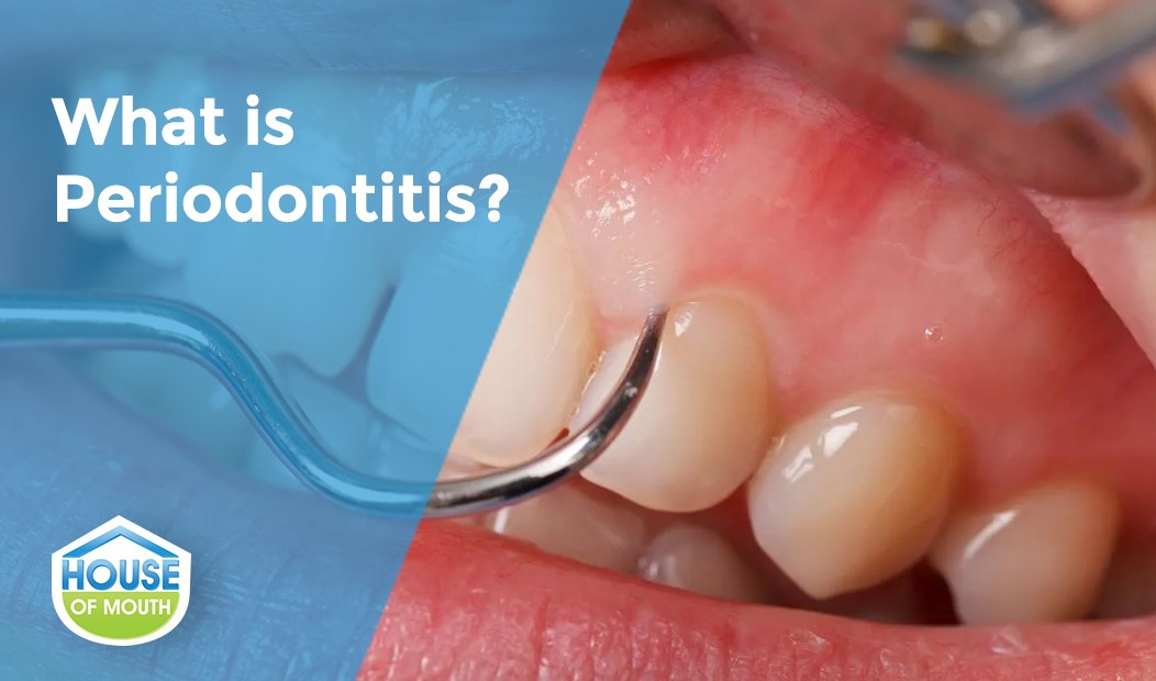 Understanding Periodontitis: Causes, Symptoms, & Treatments