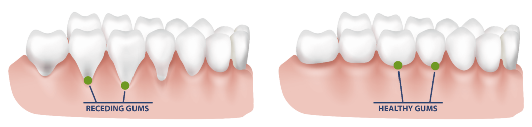 Receding Gums Vs Healthy Gum