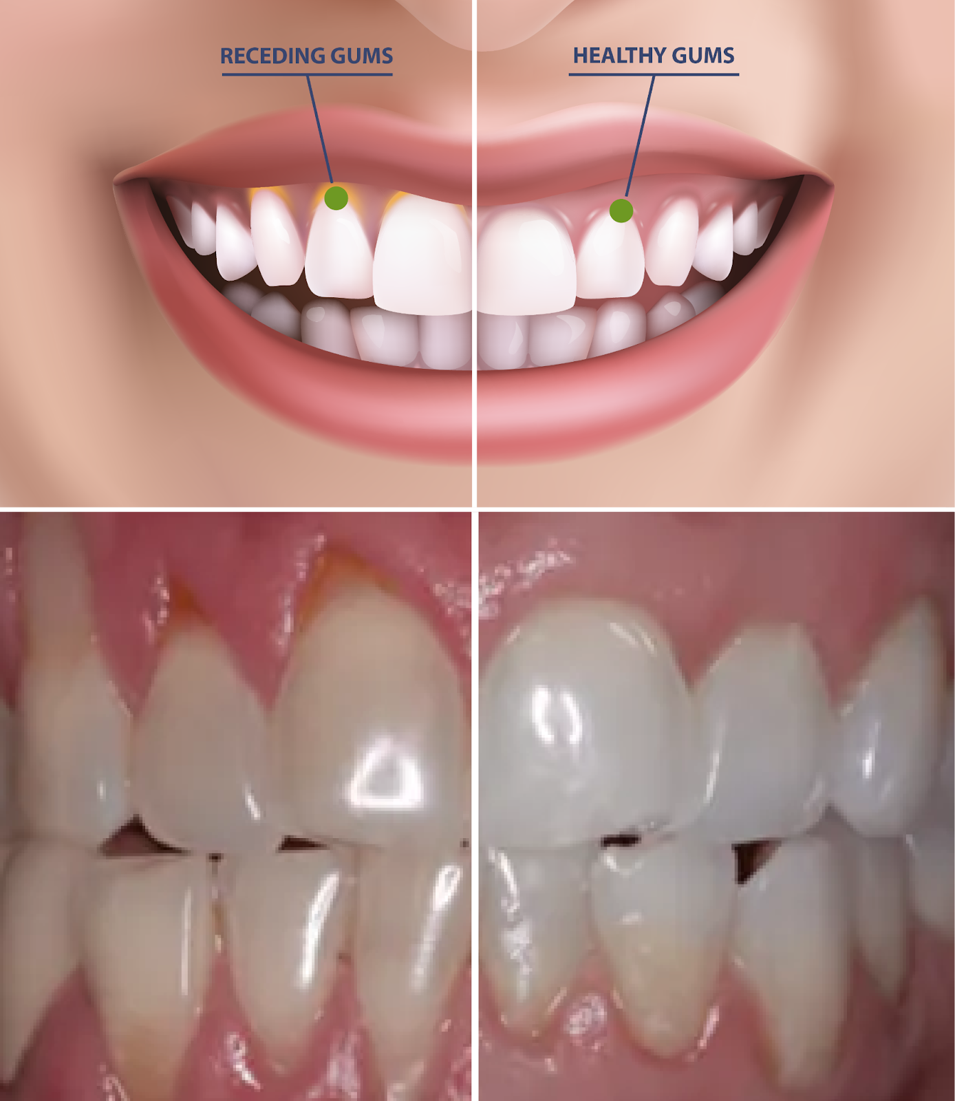 Receding Gums Vs Healthy Gums