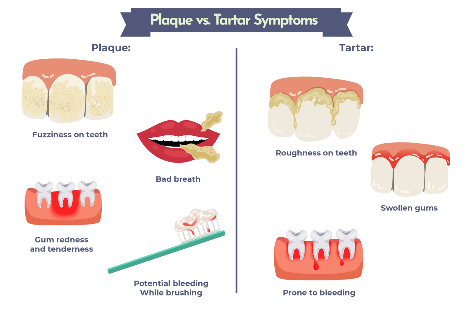 Dental Plaque And Tartar